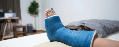 Young woman accident with bone fracture foot in plaster cast resting on the bed